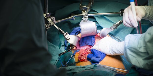 Transplantationsvorgang - Hände mit Medizinbesteck über einem geöffneten Körper Transplantationsvorgang - Hände mit Medizinbesteck über einem geöffneten Körper