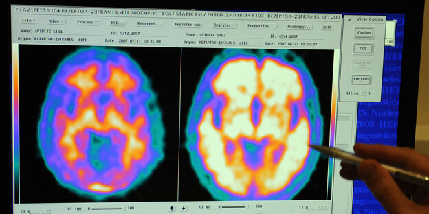 Magnetresonanztomografie (MRT): zwei Gehirne im Vergleich , ein Alzheimer-Patient (r) und ein gesunder Proband Magnetresonanztomografie (MRT): zwei Gehirne im Vergleich , ein Alzheimer-Patient (r) und ein gesunder Proband