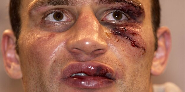 Vitali Klitschko mit großer Wunde in Gesicht Vitali Klitschko mit großer Wunde in Gesicht