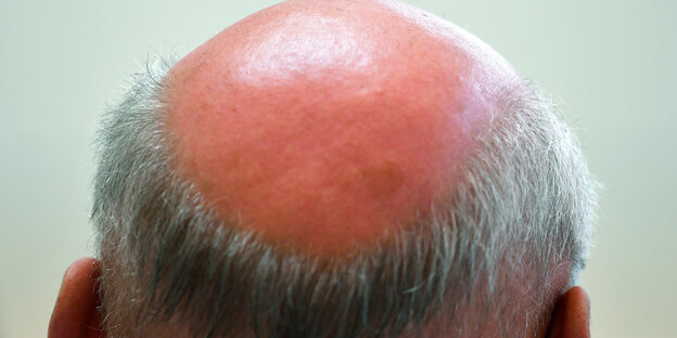 Ein Mann mit spärlichem Haarwuchs von hinten Ein Mann mit spärlichem Haarwuchs von hinten