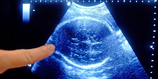 Ein Finger zeigt auf ein Ultraschallbild eines Ungeborenen Ein Finger zeigt auf ein Ultraschallbild eines Ungeborenen