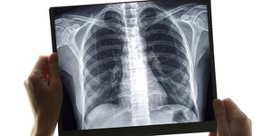zwei Hände halten eine Röntgenaufnahme eines menschlichen brustkorbs