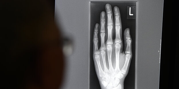 Jemand betrachtet das Röntgenbild einer Hand. Jemand betrachtet das Röntgenbild einer Hand.
