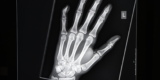Röntgenbild einer linken Hand Röntgenbild einer linken Hand