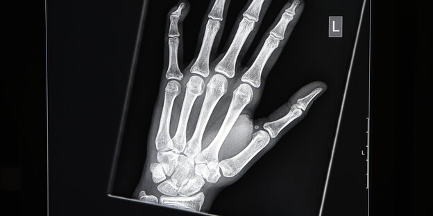 Röntgenbild einer Hand Röntgenbild einer Hand
